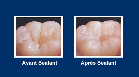 sealant site OK