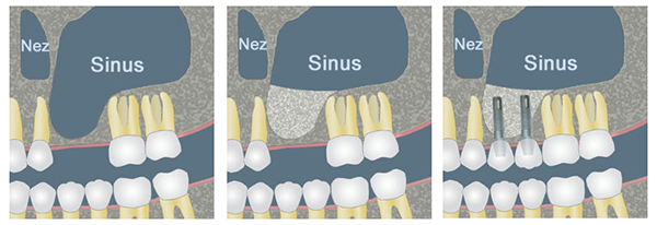 Sinus Lift